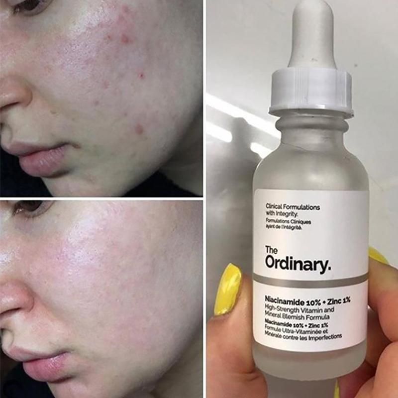 ، سرم ضد جوش و کنترل منافذ نیاسینامید + زینک اوردینری  (The Ordinary Niacinamide 10% + Zinc 1%)