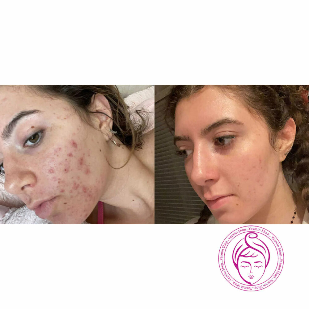 فوم شستشوی ضد جوش با 10% بنزوئیل پروکساید پانکسیل PanOxyl Acne Foaming Wash 10% Benzoyl Peroxide Maximum Strength - Image 3