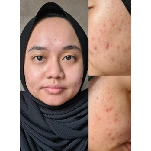 تاثیرات فوم شستشو صورت سالیسیلیک اسید مدی کیوب